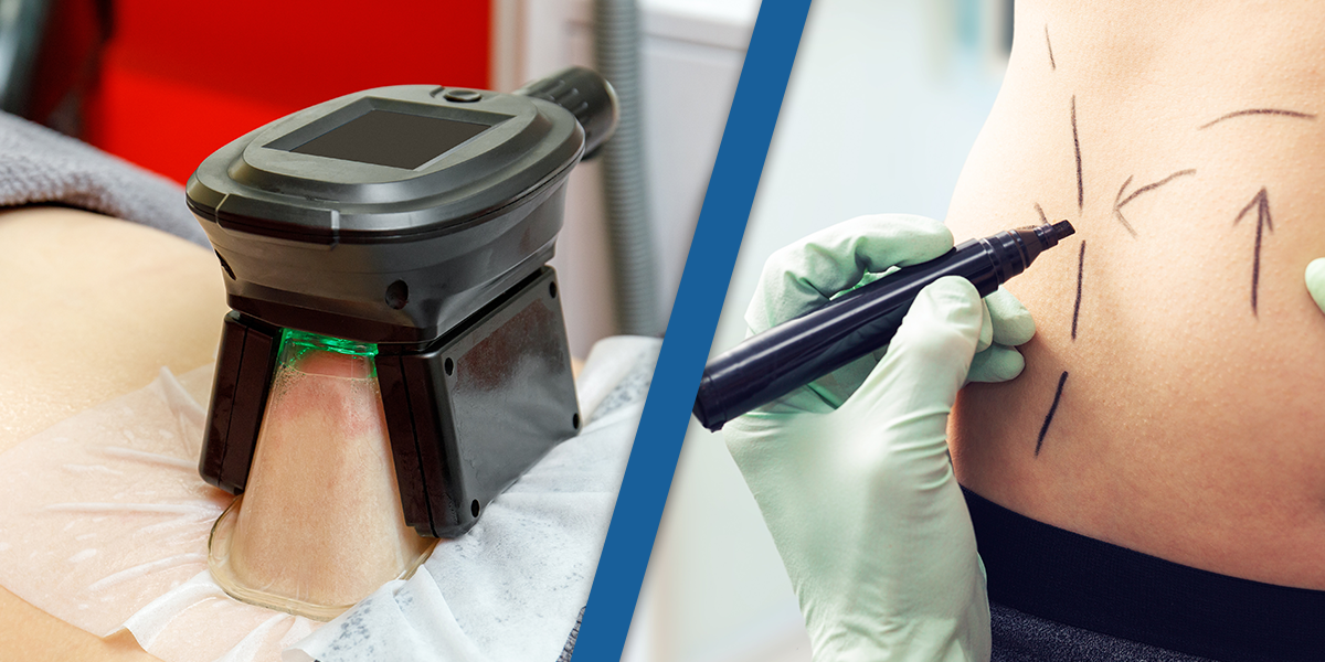 coolsculpting vs liposuction