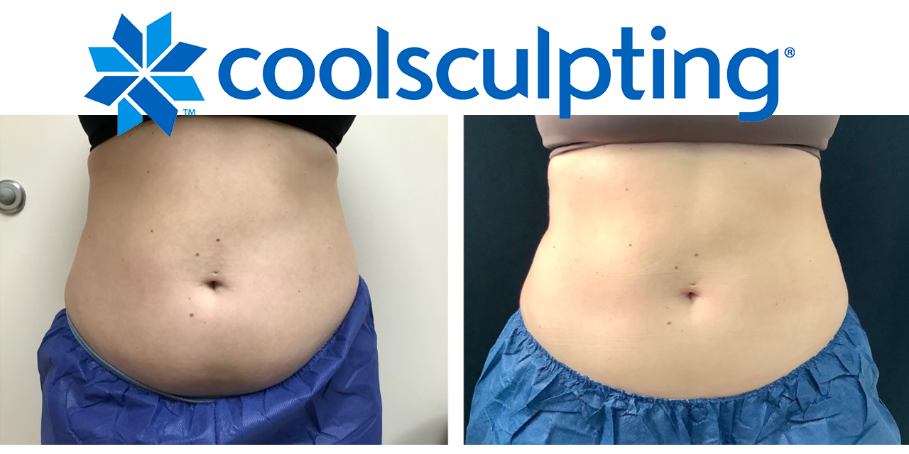 coolsculpting copy