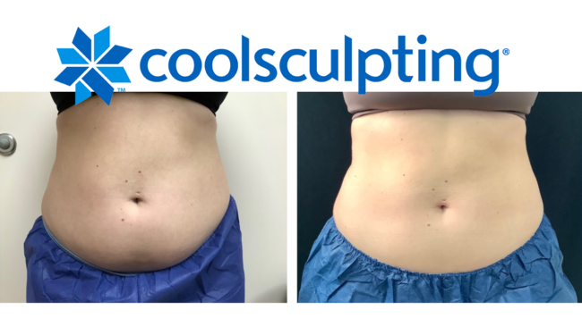 coolsculpting copy
