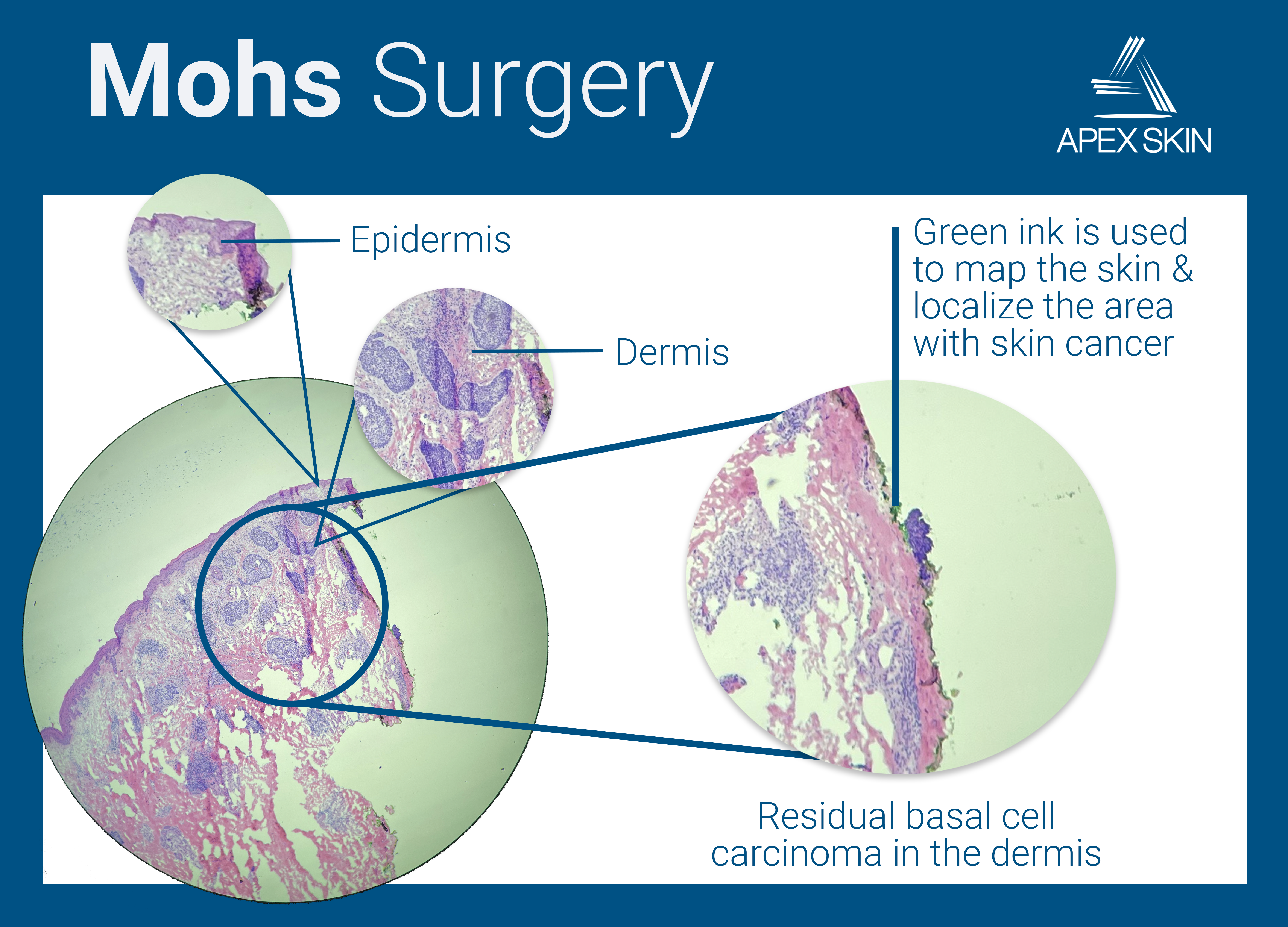 mohs surgery carcinoma