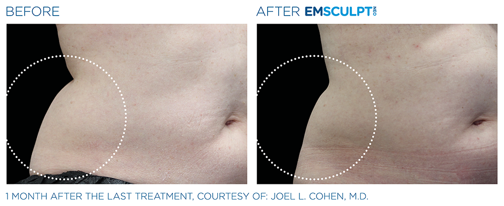Emsculpt Neo Treatments