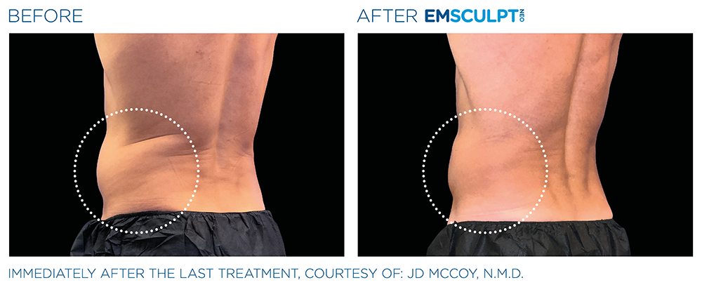 Emsculpt Neo Treatments