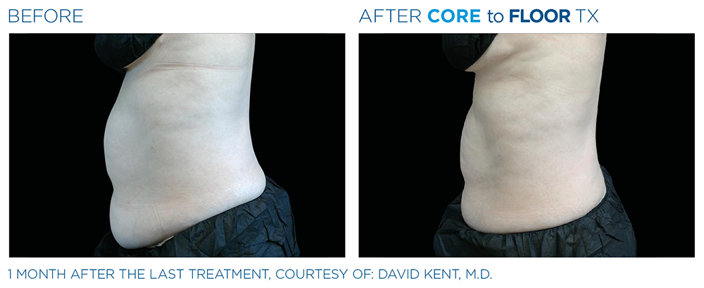 Emsculpt Neo Before and After