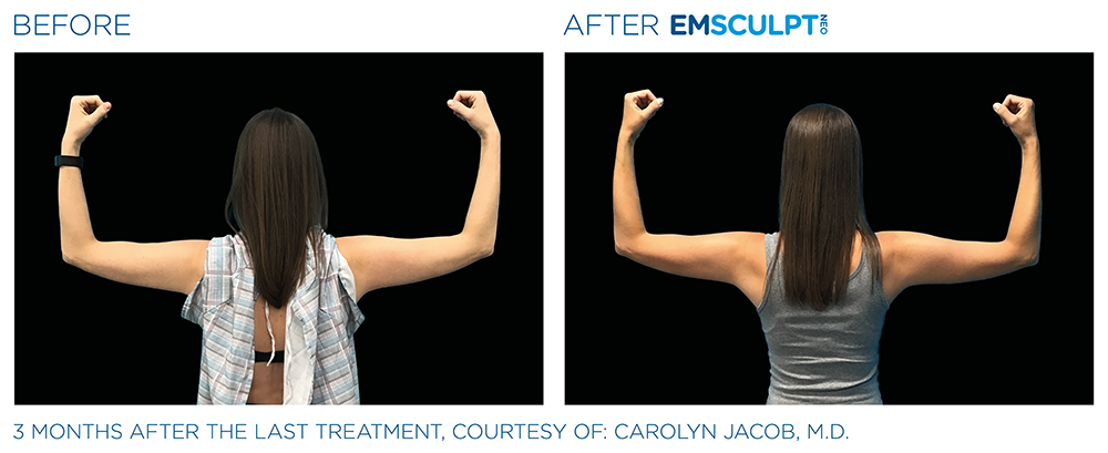 Emsculpt Neo Arms Before and After Treatment