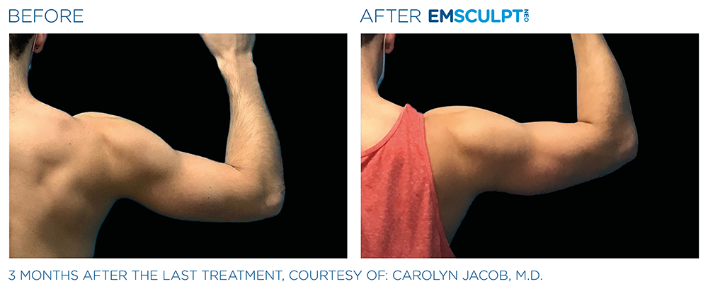 Emsculpt Neo Arms Before and After Treatment
