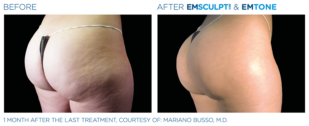 Emsculpt NEO Buttocks Before and After
