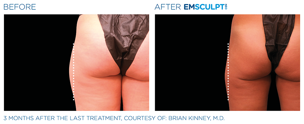 Emsculpt Neo Legs Before and After Treatment