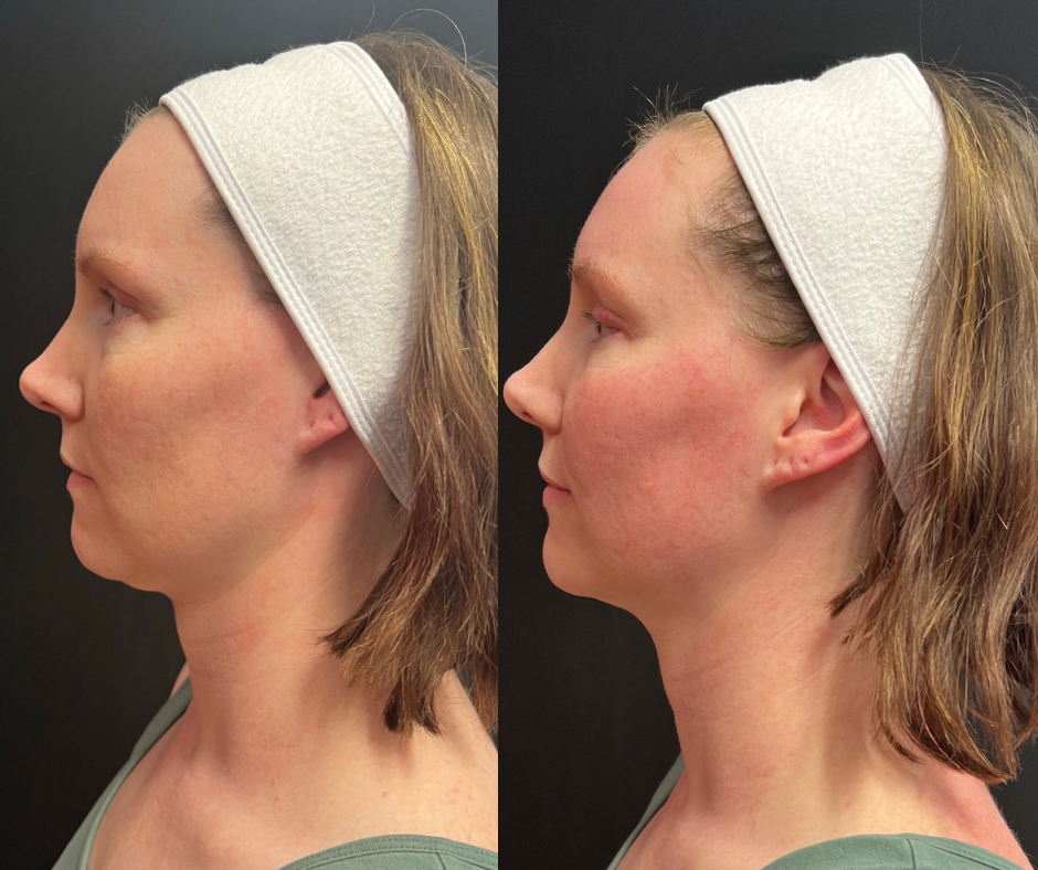Emface Facial Contouring Needleless Skin Tightening Treatments