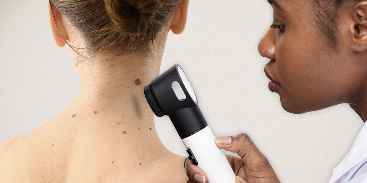 basal cell carcinoma