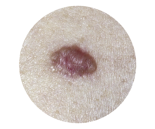 Basal Cell Carcinoma Skin Cancer Screening