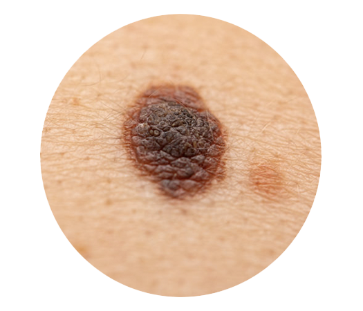 melanoma skin cancer screening