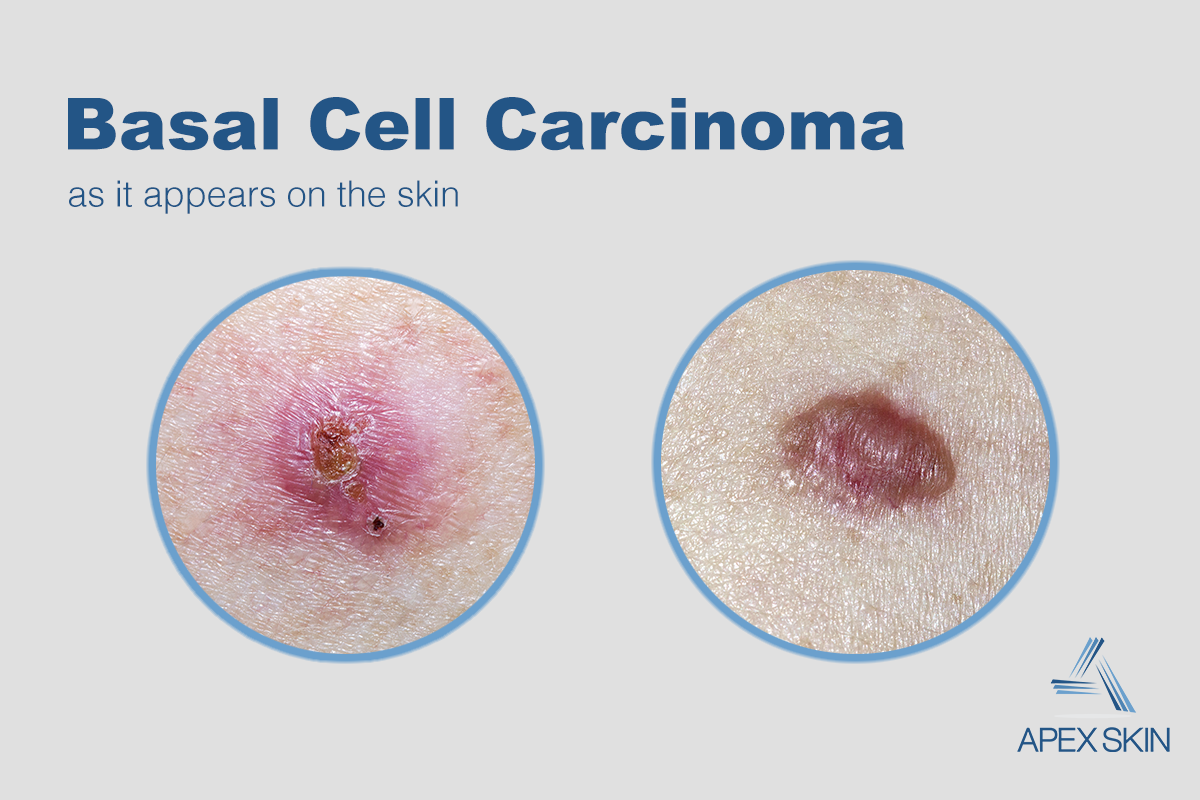 what does basal cell carcionma look like