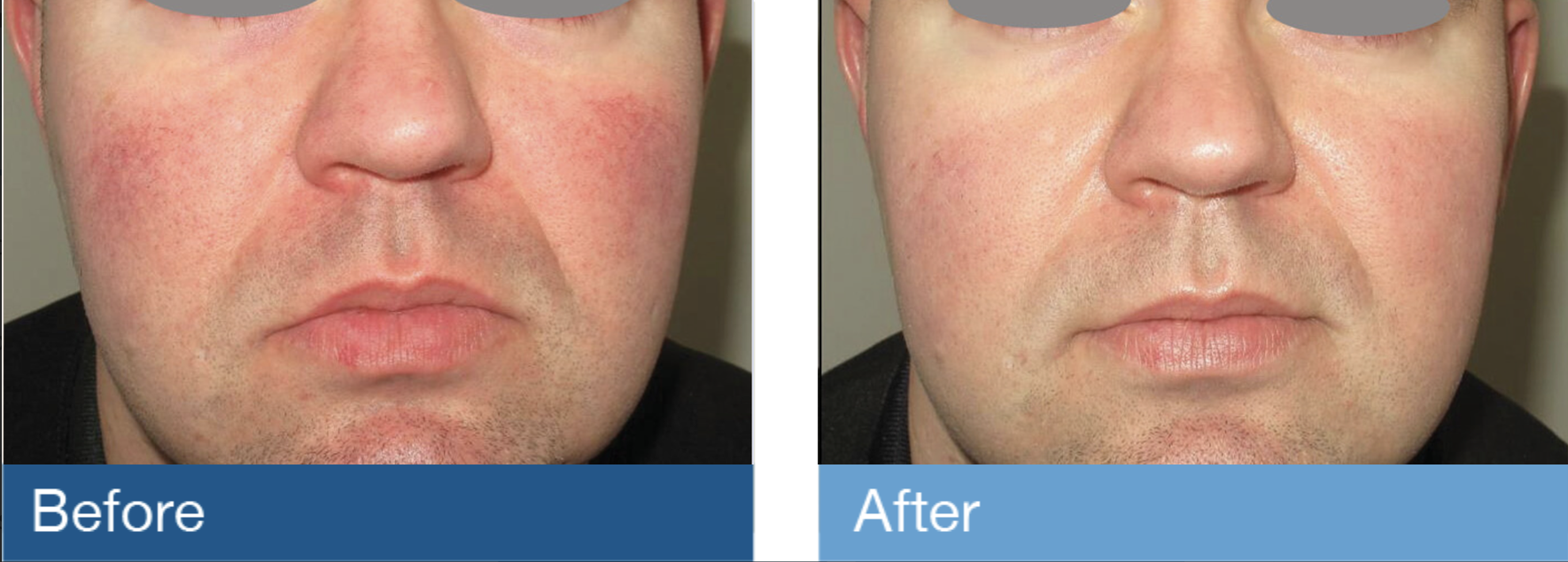 lumenis stellar m22 laser before and after