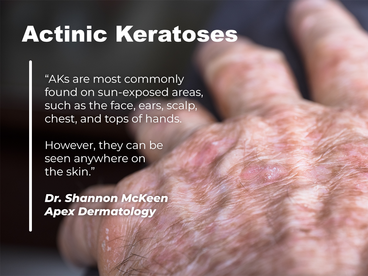 skin conditions as you age actinic keratoses
