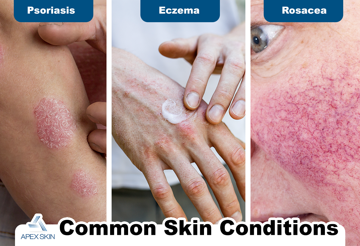 common skin conditions - Psoriasis, Eczema Rosacea common skin conditions - Psoriasis, Eczema Rosacea
