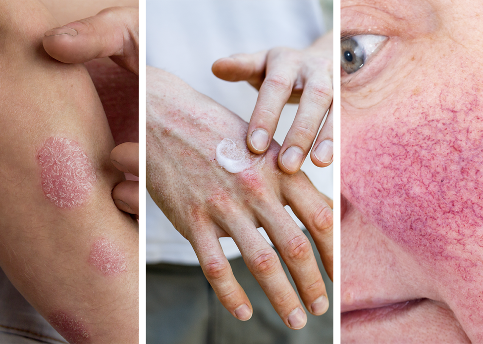 Common skin conditions - Psoriasis, Eczema Rosacea