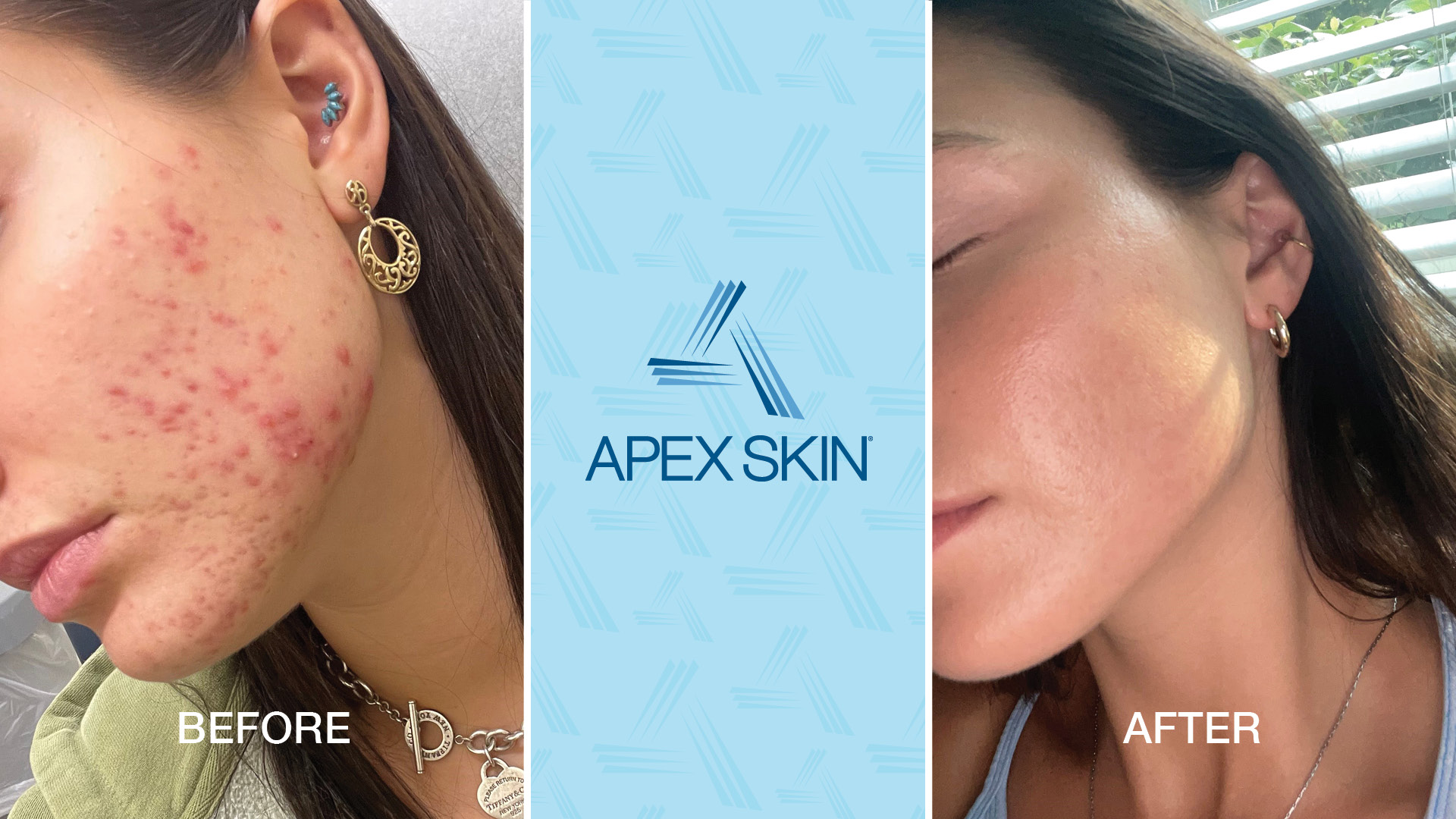 2024 Apex Patient Before After (NEW TV)–FNL Apex Patient