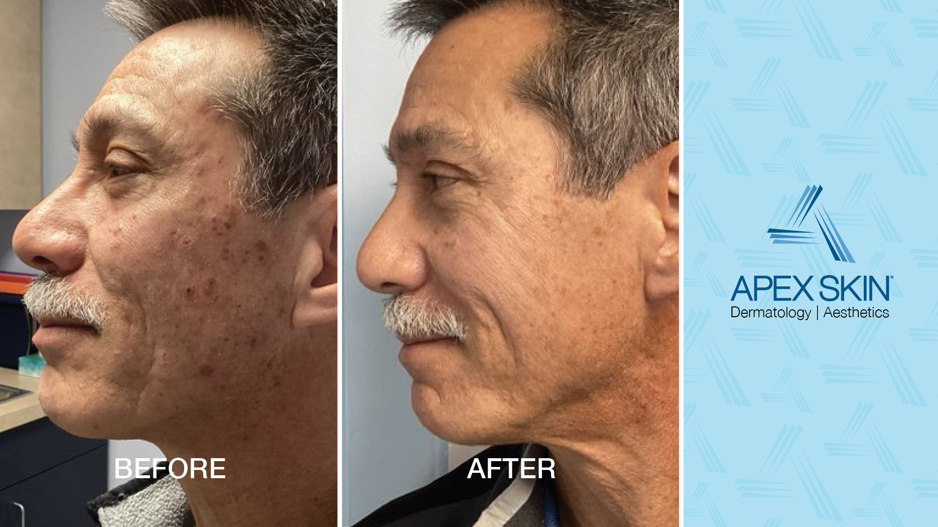 Blue Light Damage to Skin And Hair: Do Screens Actually Cause Aging 