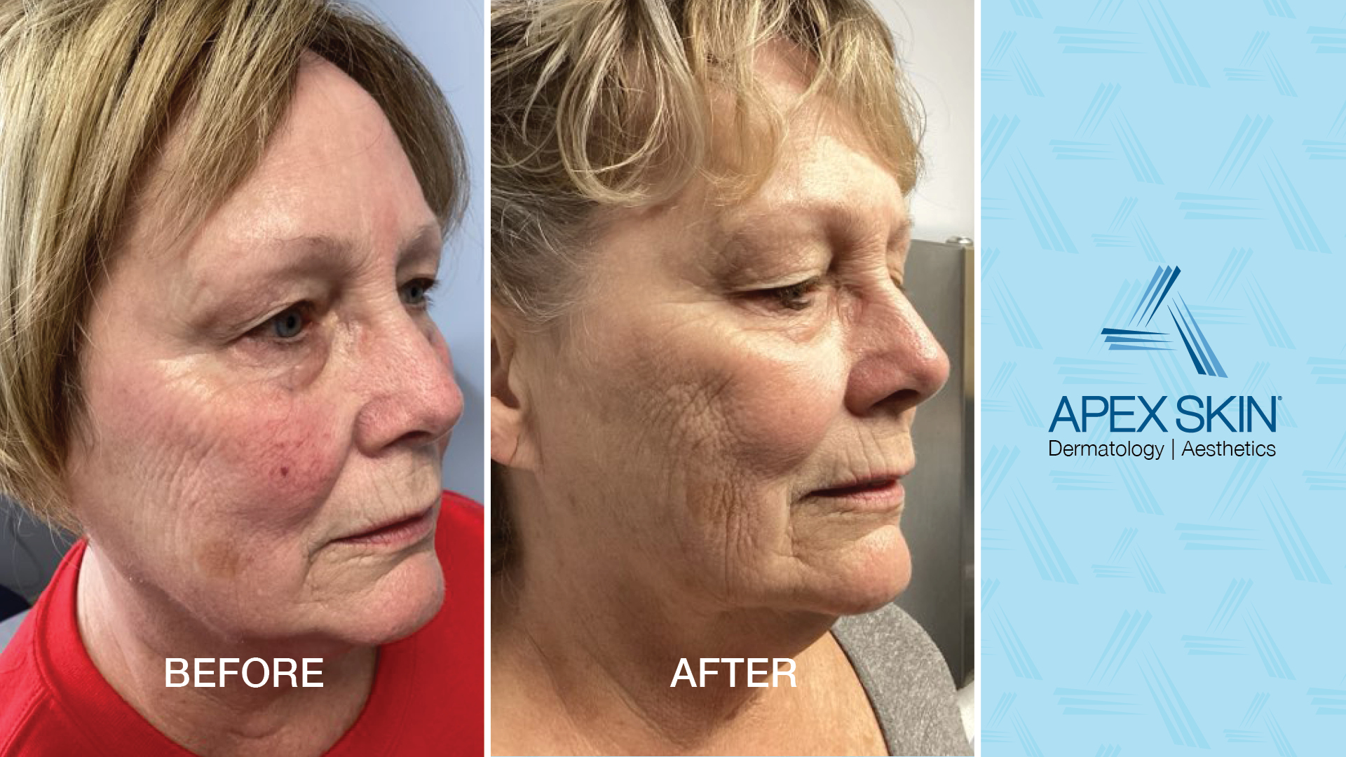 how to protect skin from blue light - Before & After