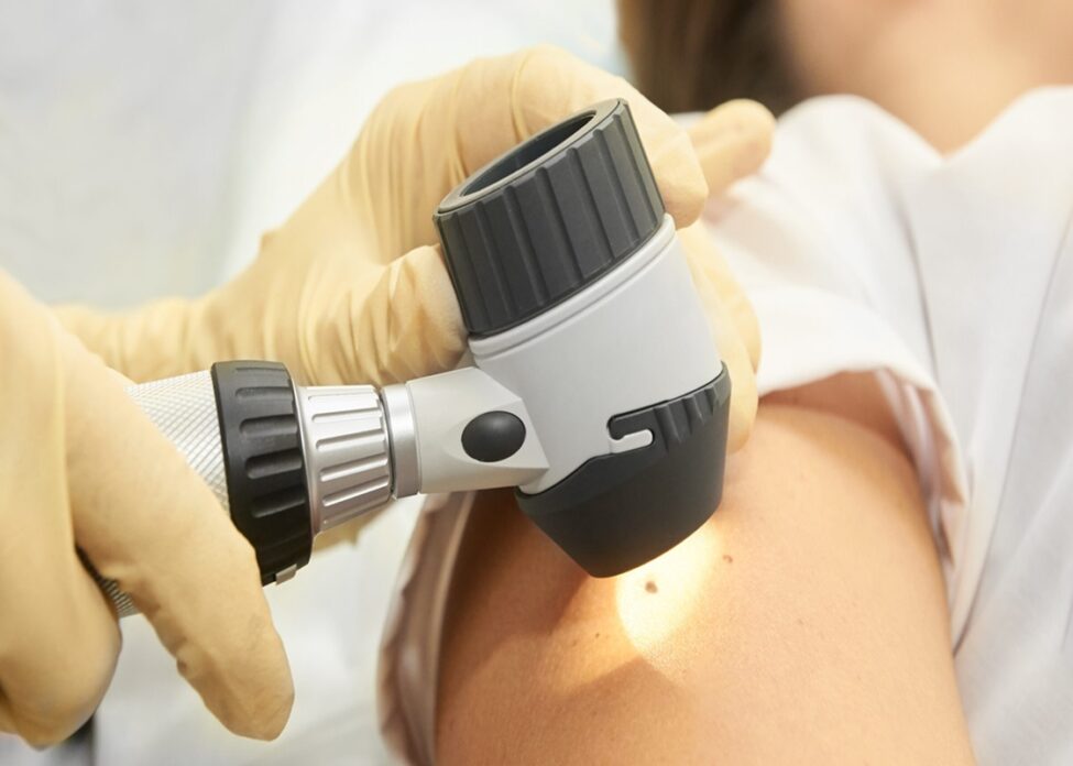 Check Mole At Hospital. Doctor Hands In Gloves. Special Equipmen