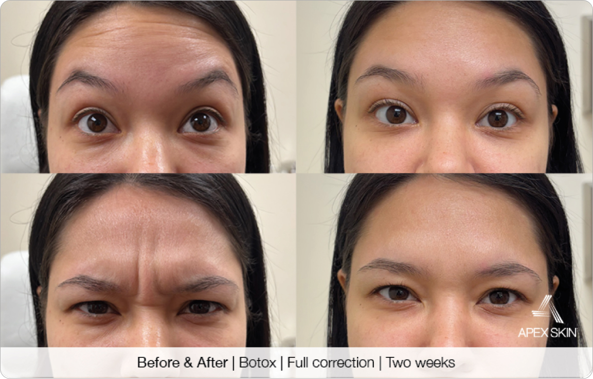 Botox Full Correction - Before & After