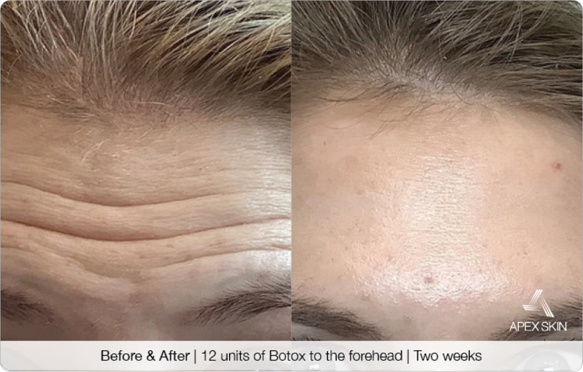 Botox - Before & After