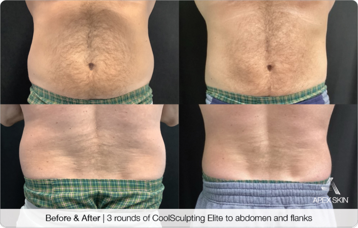 Coolsculpting Elite - Before & After