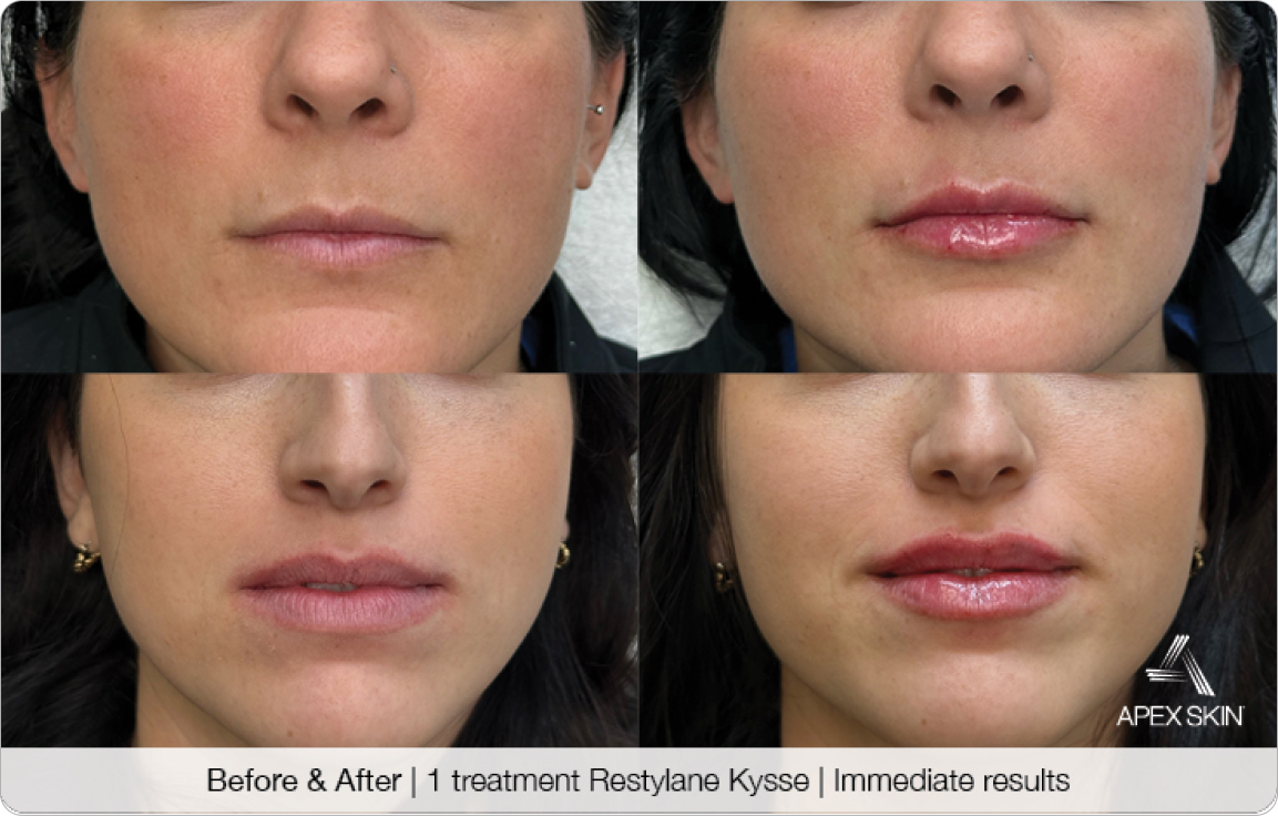 Restylane Kysse Before & After