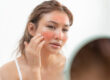 Sun Damage Treatment Dermatologist Ohio