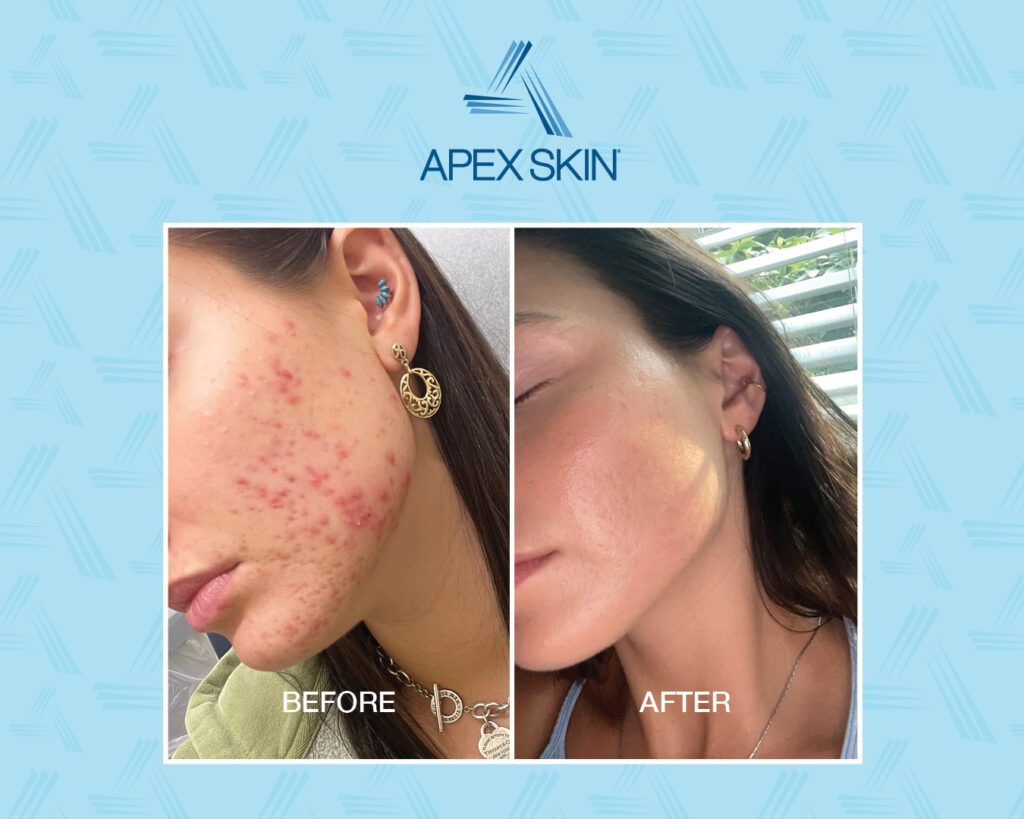 Acne in Adults Why You’re Still Breaking Out and What to Do About It
