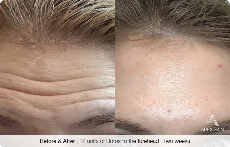 Wrinkled forehead before botox. Smooth forehead after botox.