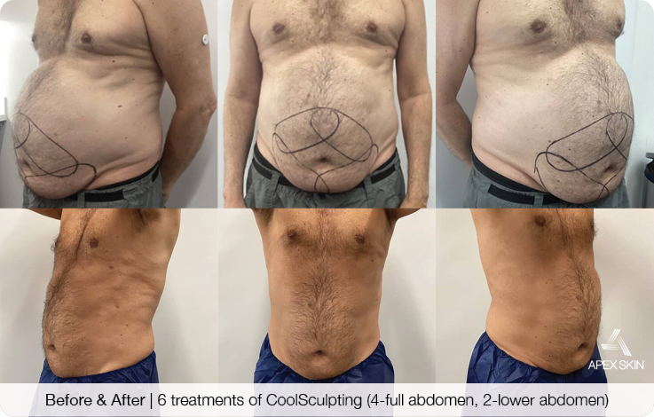 The results of CoolSculpting and body contouring