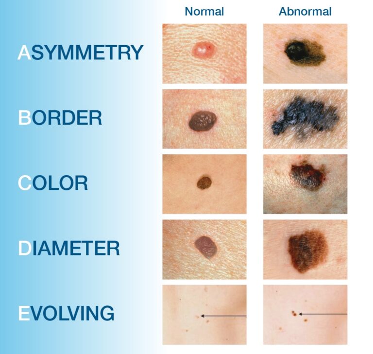 Spectrum Skin Test Full Body Skin Exam: What to Expect | Skin Cancer Screening