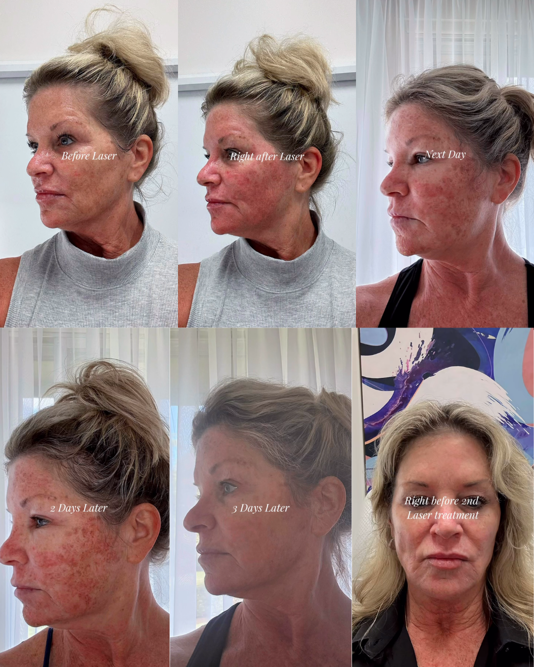 Progression of laser treatment. Before during and after of laser treatment.