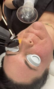 Apex Skin provider with laser Apex Skin patient getting laser on face