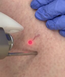 VBeam laser VBeam laser removing red marks