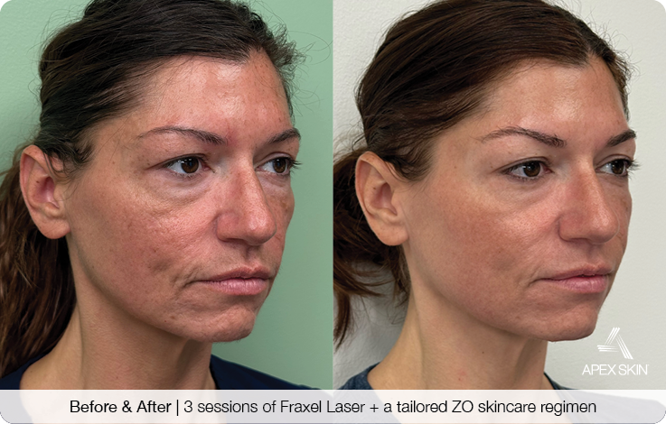 fraxel Shows the before and after results of laser from red discolored skin to smooth and glowing.