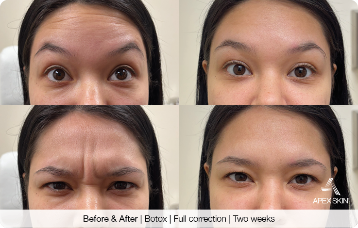Apex AESTH LP-Before+After-Botox-2 fraxek