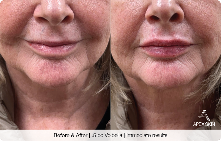 Apex AESTH LP-Before+After-Botox botox