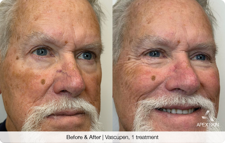 Before & After – Vascupen