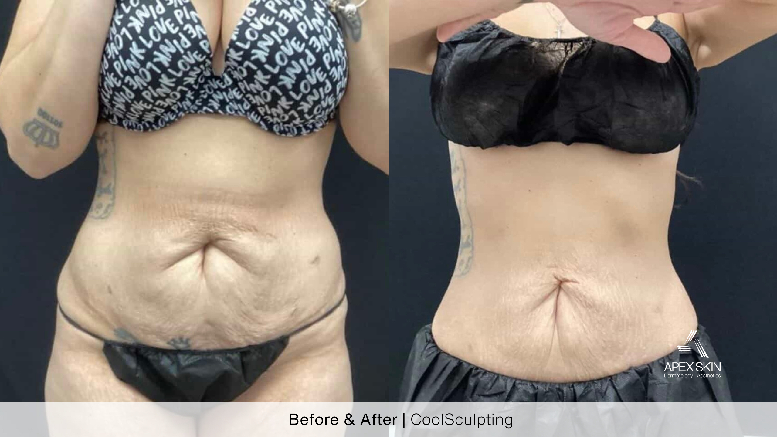 Image of woman's abdomen before and after coolsculpting treatiment.