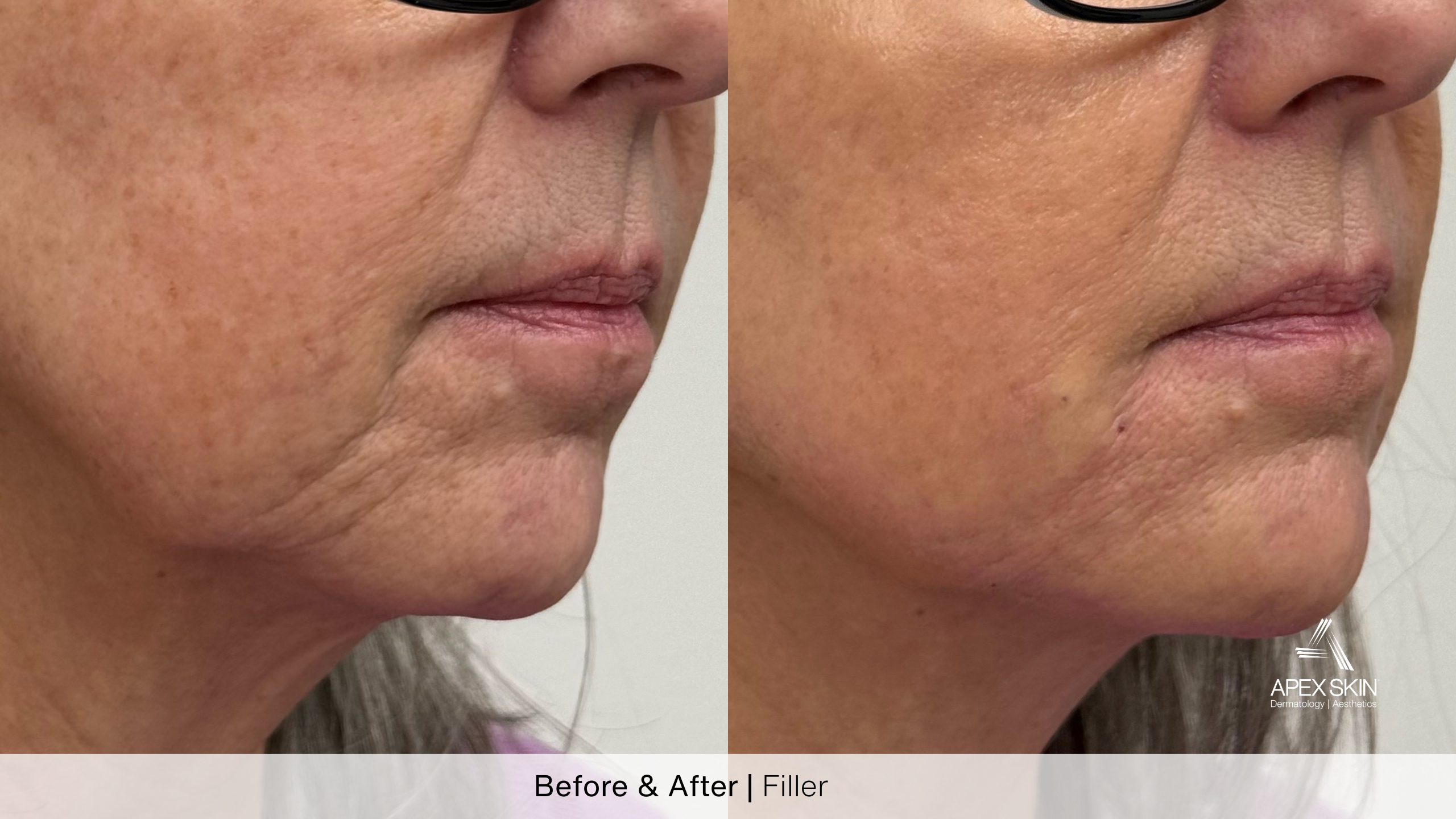 A before and after image of filler on a woman's chin and cheeks.