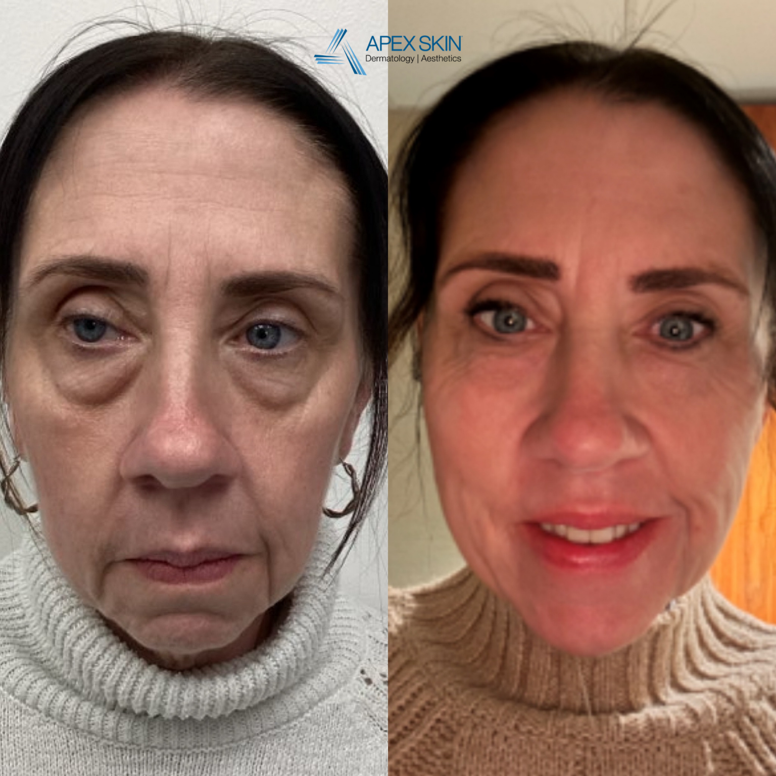 GLP-1 Weight Loss: One Patient's Full Transformation - Apex Skin