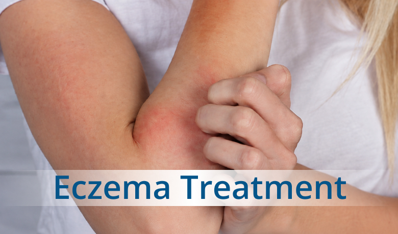 Eczema