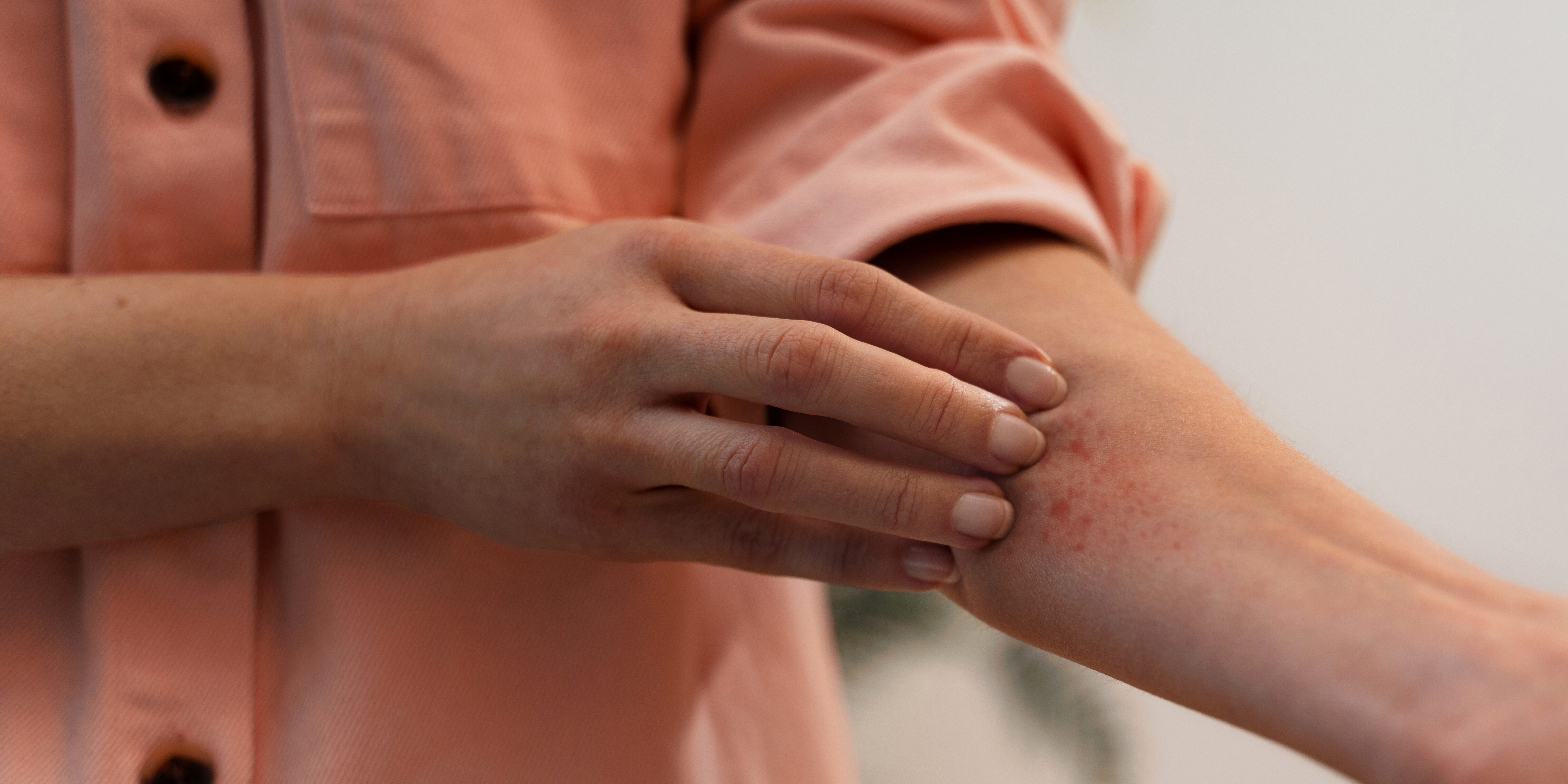 Person with eczema on arm